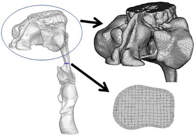 Prediction of Moderate to Severe Obstructive Sleep Apnea Using Neck Computed Tomography With Computational Fluid Dynamics Study